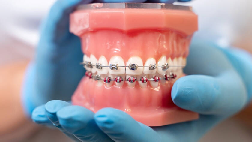 What is the need for Dental Braces, Why do we start treatment late