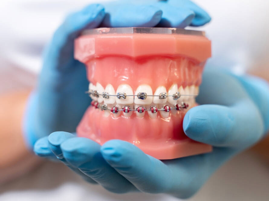 What is the need for Dental Braces, Why do we start treatment late