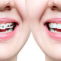 Metal Dental Braces vs Invisalign Aligners Which are Best in Lucknow