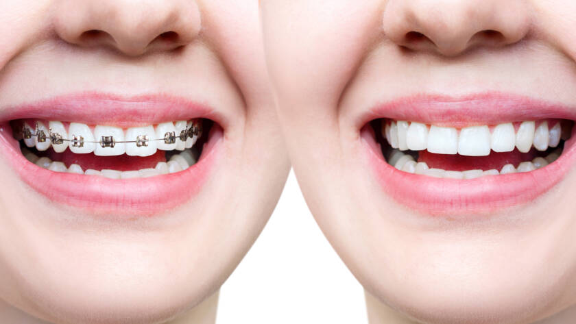 Metal Dental Braces vs Invisalign Aligners Which are Best in Lucknow