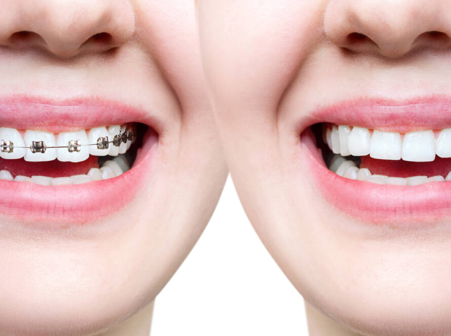 Metal Dental Braces vs Invisalign Aligners Which are Best in Lucknow